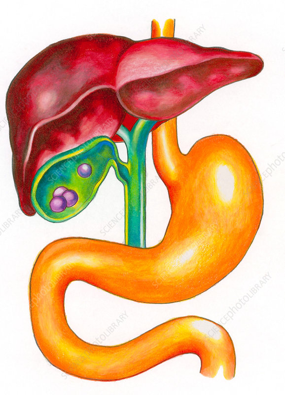 Illustration showing the liver, stomach, and gallbladder, in cross section to reveal gallstones.